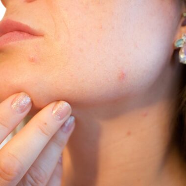 Steroid Acne: Causes, Treatment, and Prevention